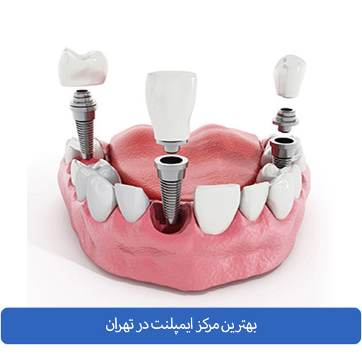 کاشت دندان در تهران ( ایمپلنت در تهران ) در بهترین کلینیک کشور انجام دهید