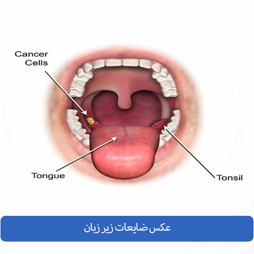 شناخت بیماری دهان و دندان از روی عکس ضایعات زیر زبان