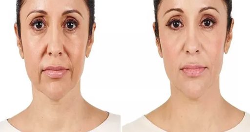 تزریق ژل خنده چیست؟ چه عوارضی دارد؟
